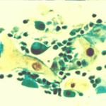 Ανισοκυττάρωση